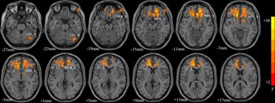 CACNA1C Gene rs11832738 Polymorphism Influences Depression Severity by Modulating Spontaneous Activity in the Right Middle Frontal Gyrus in Patients With Major Depressive Disorder